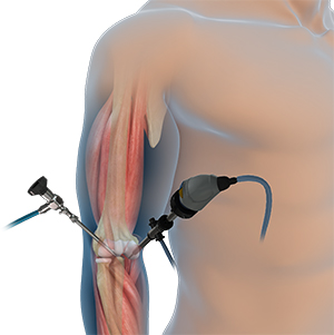 Elbow Arthroscopy